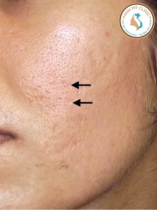 x&oacute;a sẹo rổ